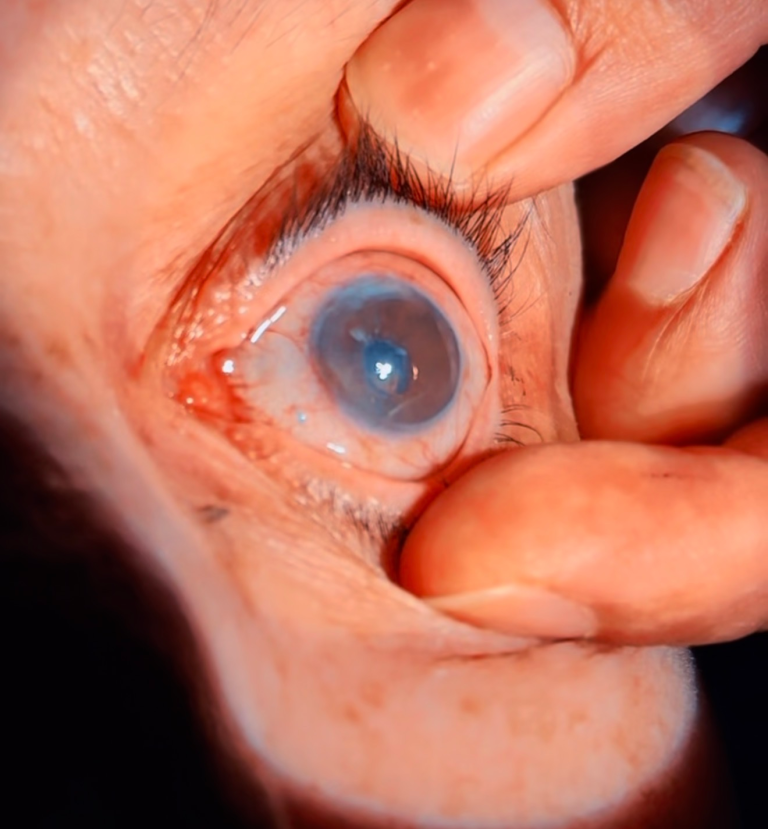 trasplantes de cornea una decada devolviendo la vista en baja california sur 5.webp